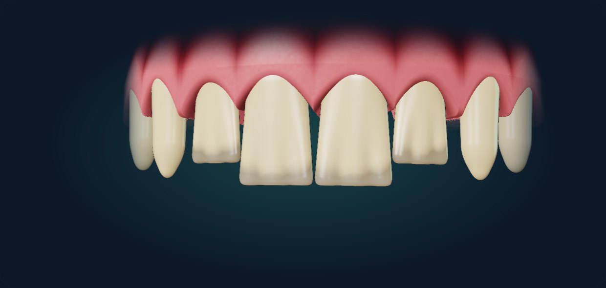 Rendered incisor at shade A1