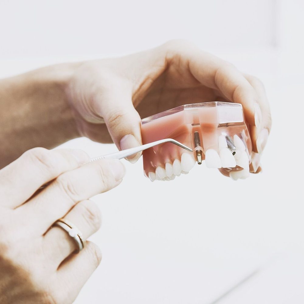 Hands holding a model of teeth with an implant