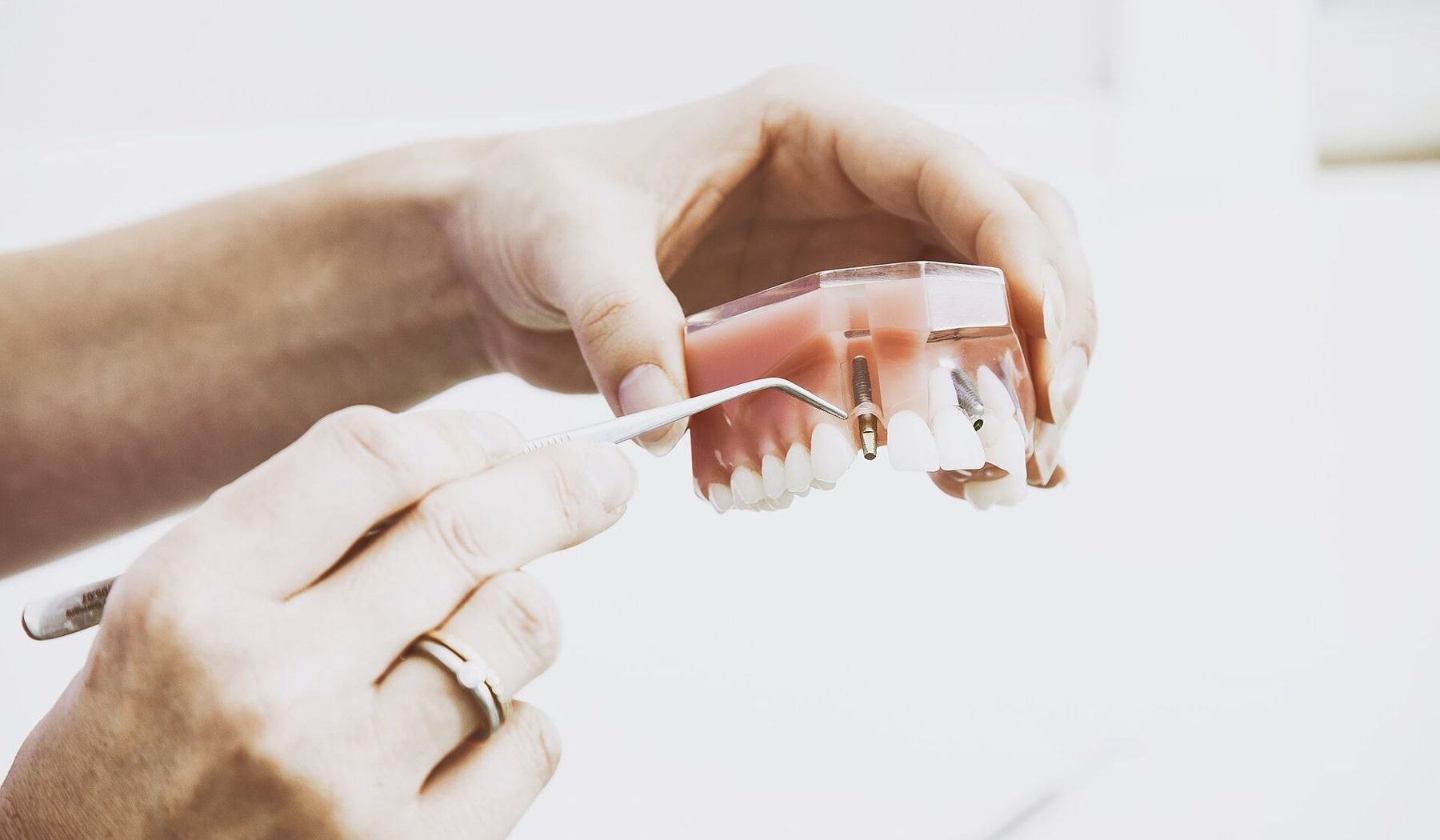 Hands holding a model of teeth with an implant